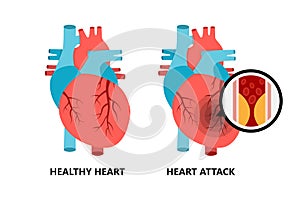 Healthy and unhealthy heart. Heart with atherosclerotic plaque.