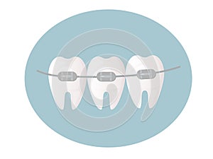 Healthy white and straight teeth with braces. Dental care service - Orthodontic treatment and straightening of teeth