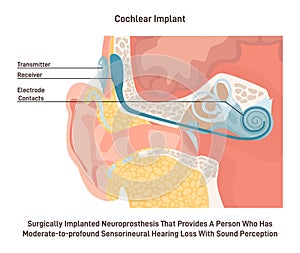 Hearing aid or cochlear implant. Surgically implanted neuroprosthesis photo