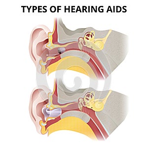 Hearing aid, in-ear sectional view, different types of devices