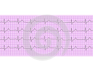 Heart analysis, electrocardiogram graph