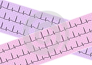 Heart analysis, electrocardiogram graph (ECG)