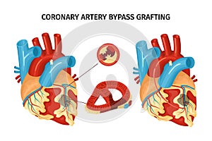 Heart Anatomy Bypass Illustration
