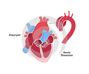 Heart anatomy disease infographic chart. Vector color flat illustration. Inner organ cross section with aortic aneurism dissection