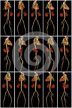 Heart, aorta and kidneys on computed tomography