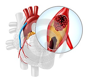 Heart Artery Bypass Grafting