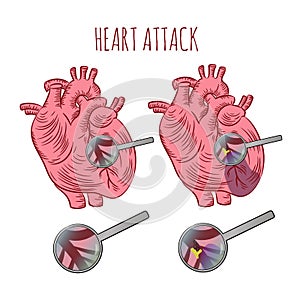 HEART ATTACK Atherosclerosis Medicine Education Vector Scheme photo