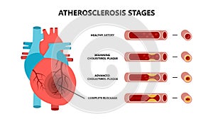 Heart attack and atherosclerosis stages. Healthy artery, beginning cholesterol plaque, advanced cholesterol plaque