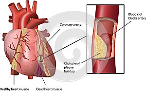 Corazón ataque causado por de acuerdo a 