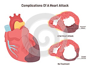 Heart attack complications. Heart wall thining and ventricle enlargening