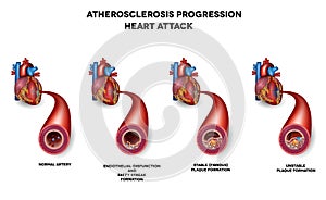 Corazón ataque infarto de miocardio artería enfermedad 