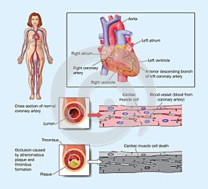 Heart attack due to blocked artery