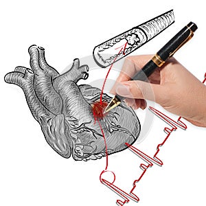 Heart Attack and heart beats cardiogram