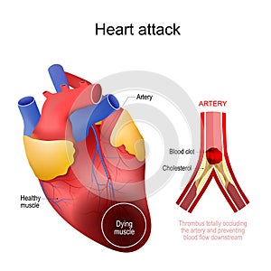 Heart attack. myocardial infarction