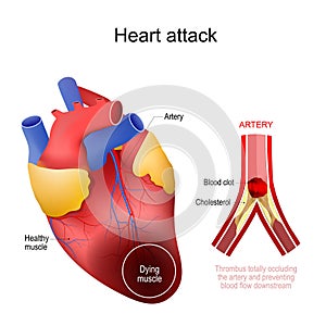 Heart attack. myocardial infarction photo