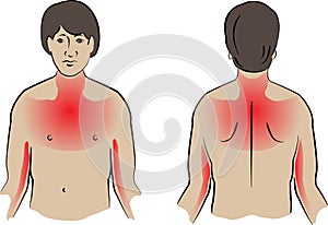 Heart Attack Pain Locations medical illustration