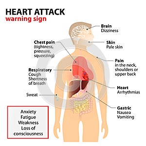 Heart attack symptoms