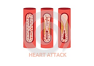 Heart attack symptoms vector