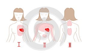 Heart attack vector infographic. Heart attack symptoms. How to recognize a heart attack