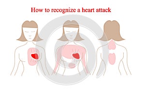 Heart attack vector infographic. Heart attack symptoms. How to recognize a heart attack