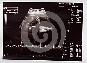 Heart beat of baby in pregnant woman belly