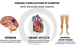 Heart and blood vessel diseases