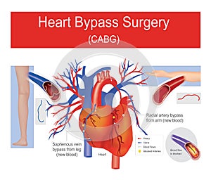 Heart bypass surgery.