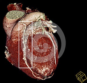 Heart bypass surgery. CT-scan reconstruction