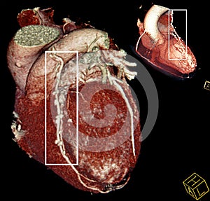 Heart bypass surgery. Multy-planar CT