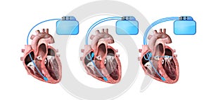 Heart and cardiac pacemaker on white background 3d render, heart anatomy, section, right and left ventricle, atria, valves