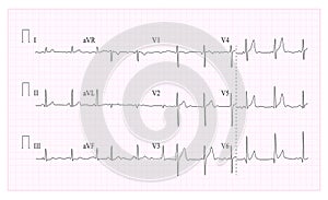 Heart Cardiogram Chart Vector. Illustration Of Wave Form On Checked Ecg Graph. Heart Rhythm, Ischemia, Infarction. Vitality Heartb