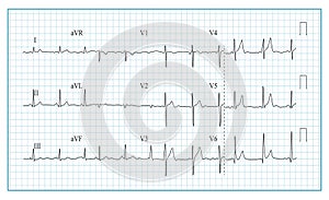 Heart Cardiogram Chart Vector. Illustration Of Wave Form On Checked Ecg Graph. Heart Rhythm, Ischemia, Infarction. Vitality Heartb photo
