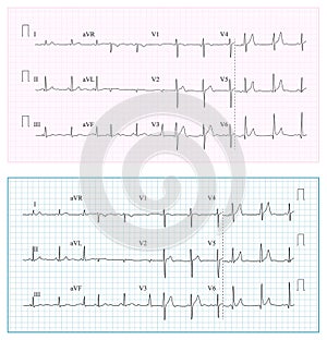 Heart Cardiogram Chart Vector. Set Healthy Heart Rhythm, Ischemia, Infarction. Vitality Heartbeat photo