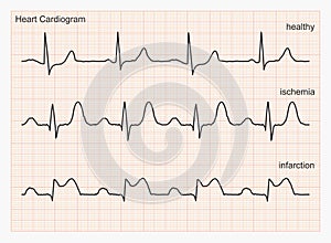 Heart cardiogram waves.