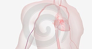 The In heart catheterization through the radial artery, the cath