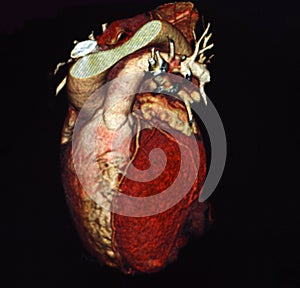 Heart Computed Tomography