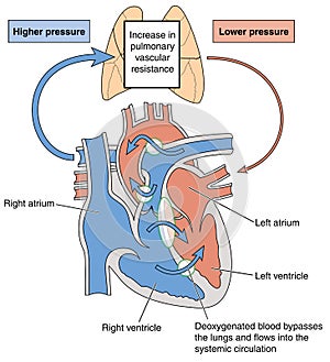 Heart defects causing Eisenmenger syndrome