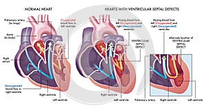 Heart defects photo