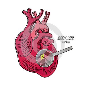 HEART DISEASE Atherosclerosis Medicine Education Vector Scheme photo