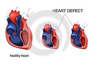 Heart disease. defect photo