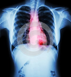 Heart disease ( Film chest x-ray of woman with heart disease )