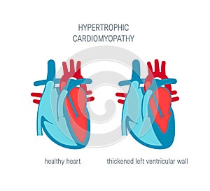 Heart disease vector concept in flat style