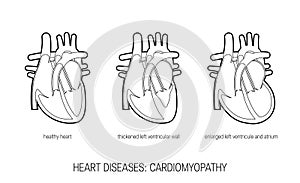 Heart diseases concept in flat style, vector
