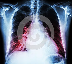 Heart failure ( film x-ray chest PA upright : show cardiomegaly and interstitial infiltrate both lung )