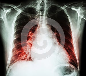 Heart failure ( film x-ray chest PA upright : show cardiomegaly and interstitial infiltrate both lung ) photo