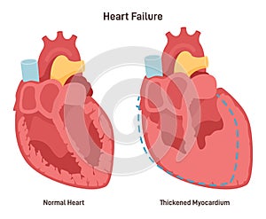 Heart failure, impairment of the blood pumping function. Healthy heart
