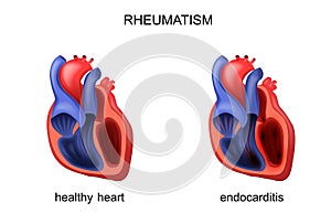 Heart healthy and diseased endocarditis