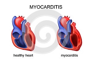 Heart healthy and diseased myocarditis photo