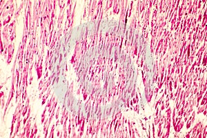 Heart hypertrophy photomicrograph