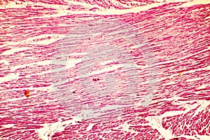 Heart hypertrophy photomicrograph photo